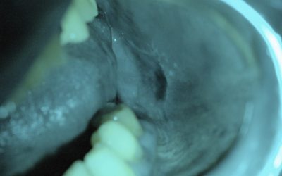 Utilizzo dell’autofluorescenza nella diagnosi precoce del cancro orale